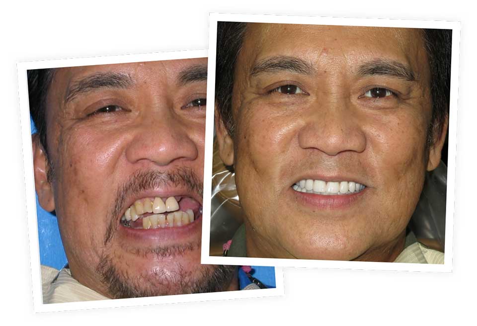 Dental Implants Before & After
