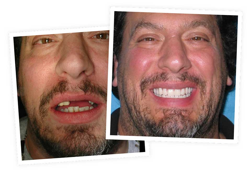 Dental Implants Before & After