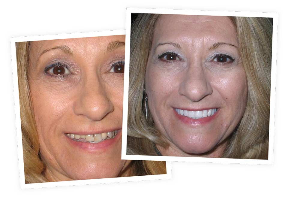 Dental Implants Before & After